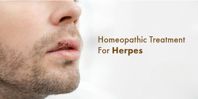 Homeopathic Treatment For Herpes