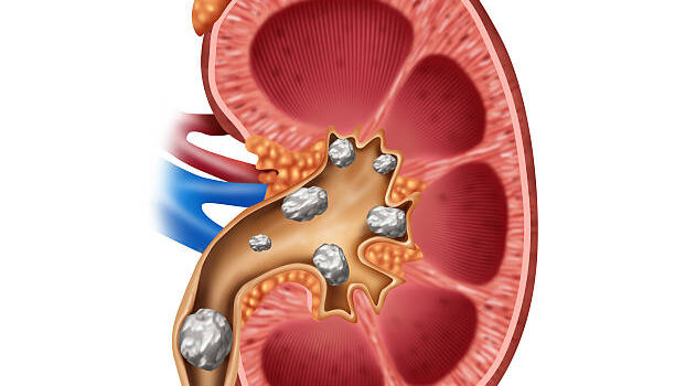 Homeopathy Effective Treatment For Kidney Stones
