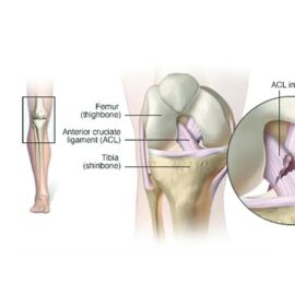 Anterior Cruciate Ligament (ACL) Injuries Healing with Homeopathy