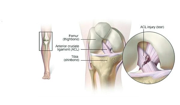 Anterior Cruciate Ligament (ACL) Injuries Healing with Homeopathy