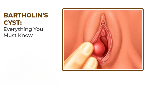 What is Bartholin’s Cyst?