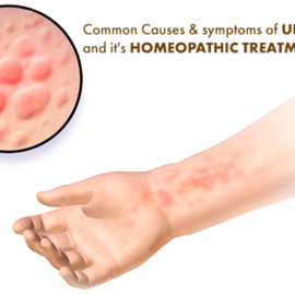 Common Causes & Symptoms Of Urticaria And It’s Homeopathic Treatment