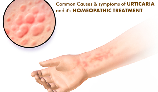 Common Causes & Symptoms Of Urticaria And It’s Homeopathic Treatment
